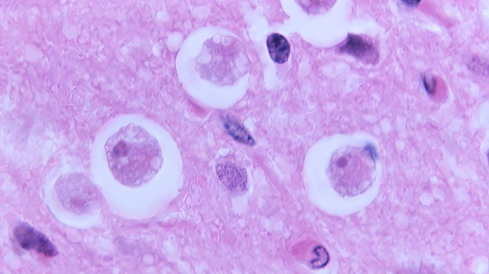 Brain-eating amoeba kills 19 in India  --  RT India