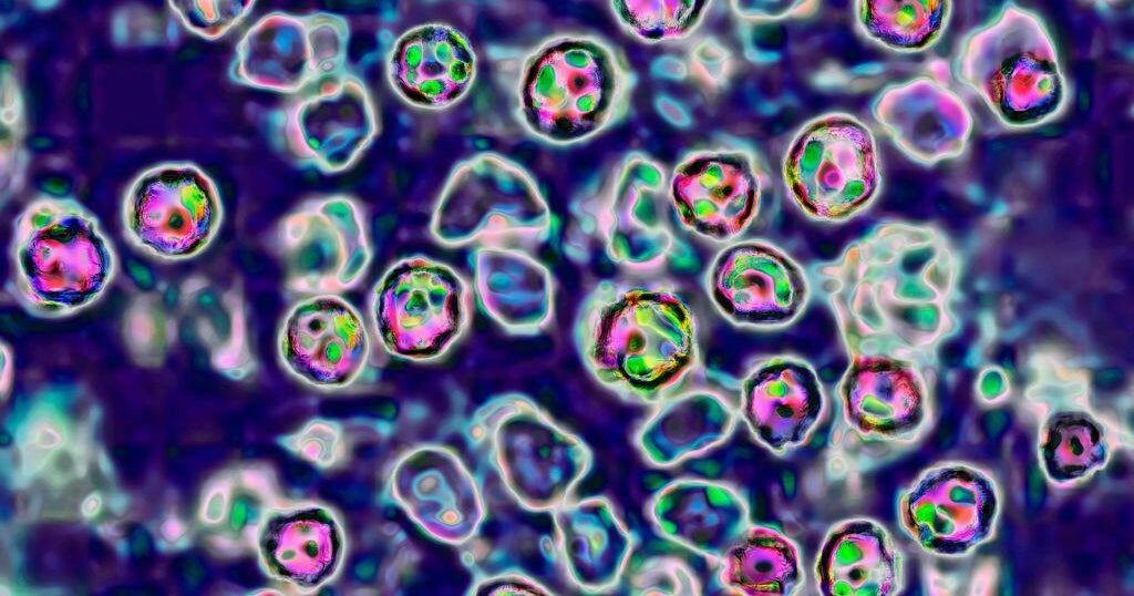 Health officials monitoring 5 exposed to Fulton County measles case