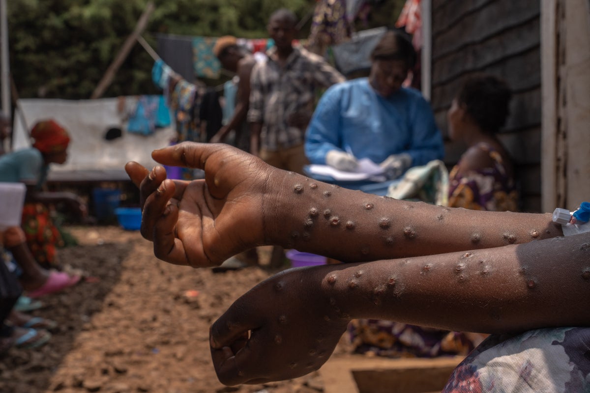 How an Mpox outbreak revealed an epidemic of untreated HIV in Sierra Leone