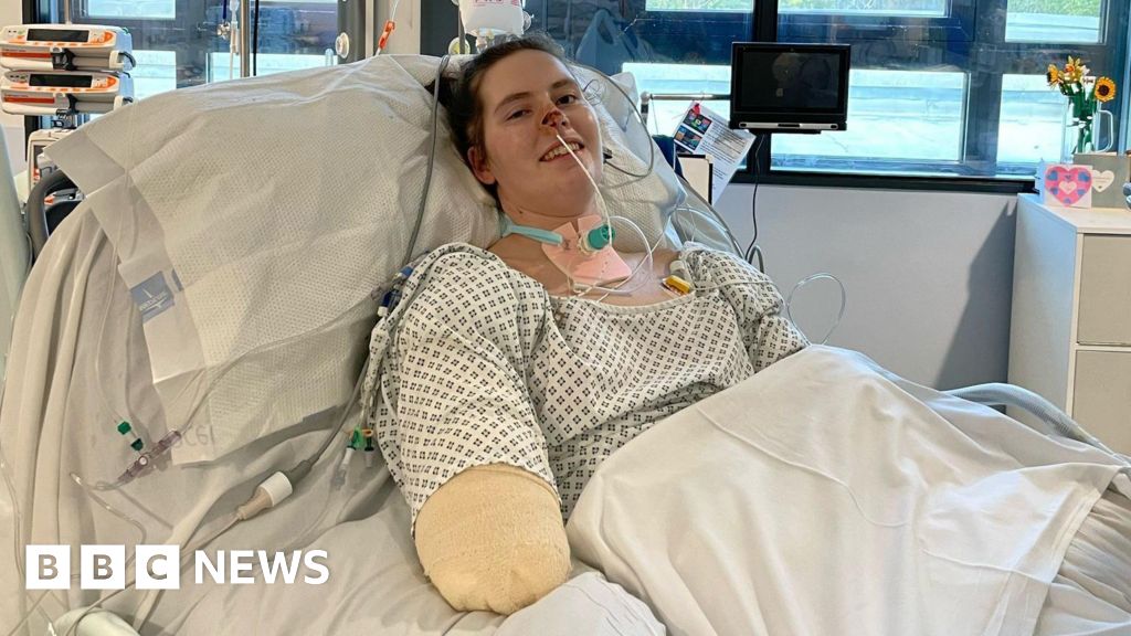 Jersey amputee making exceptional progress - physiotherapist