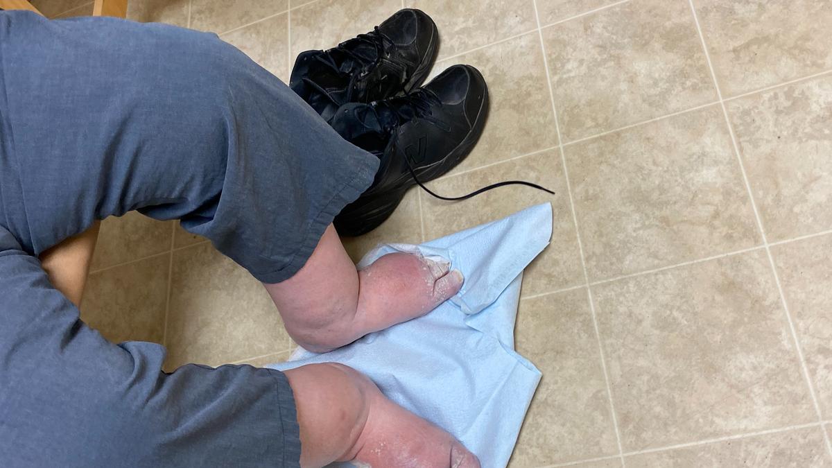 Not merely puffy feet: what pedal oedema can signify about your health