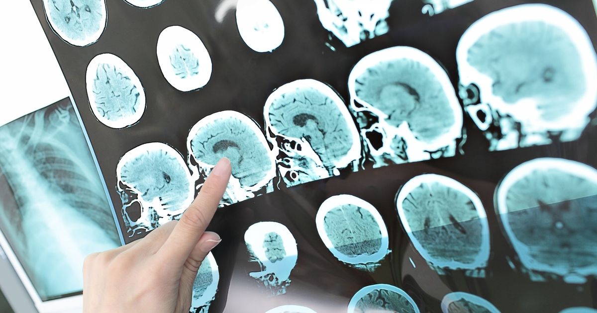 Thousands in UK have disease that can cause dementia if untreated - The Mirror