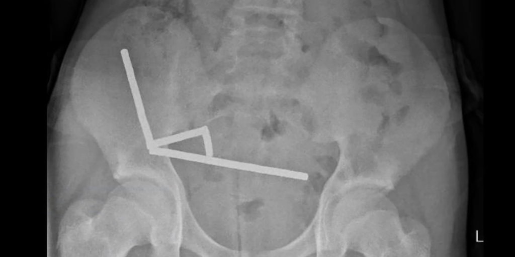 Boy who swallowed 100 magnets has surgery to remove them from his gut