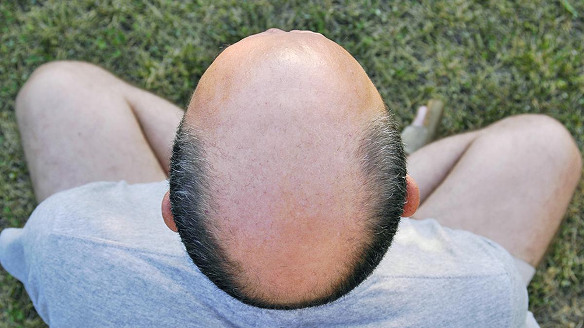 Bald truths: the high cost of quick-fix hair cures in Hyderabad