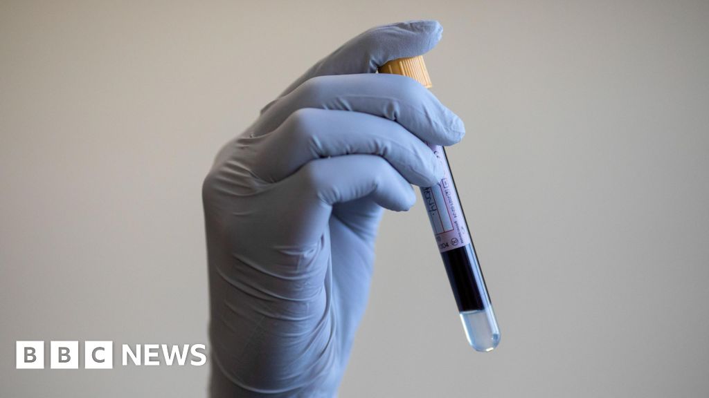 Possible over-testing for prostate cancer, say Oxford researchers