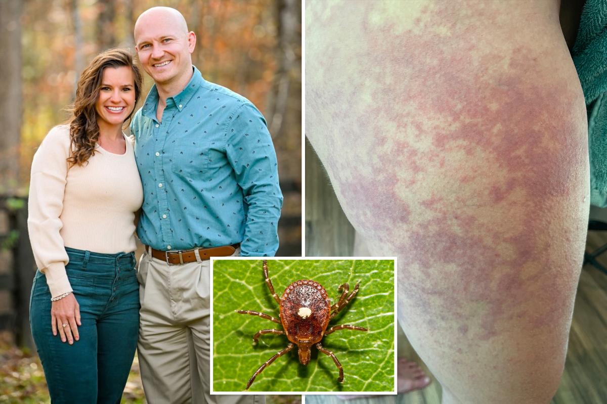 I live with alpha-gal syndrome  --  a tick-borne illness that makes...