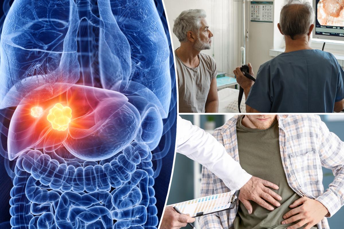 This 'troubling' colorectal cancer complication is highest in...