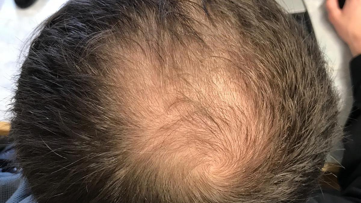 All you need to know about: male pattern baldness