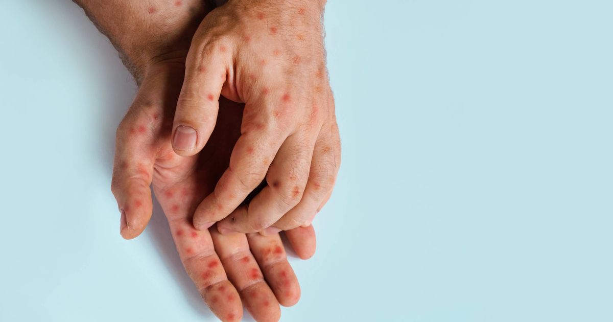 New mpox strain detected in UK is 'precisely what experts feared would happen' - Daily Star