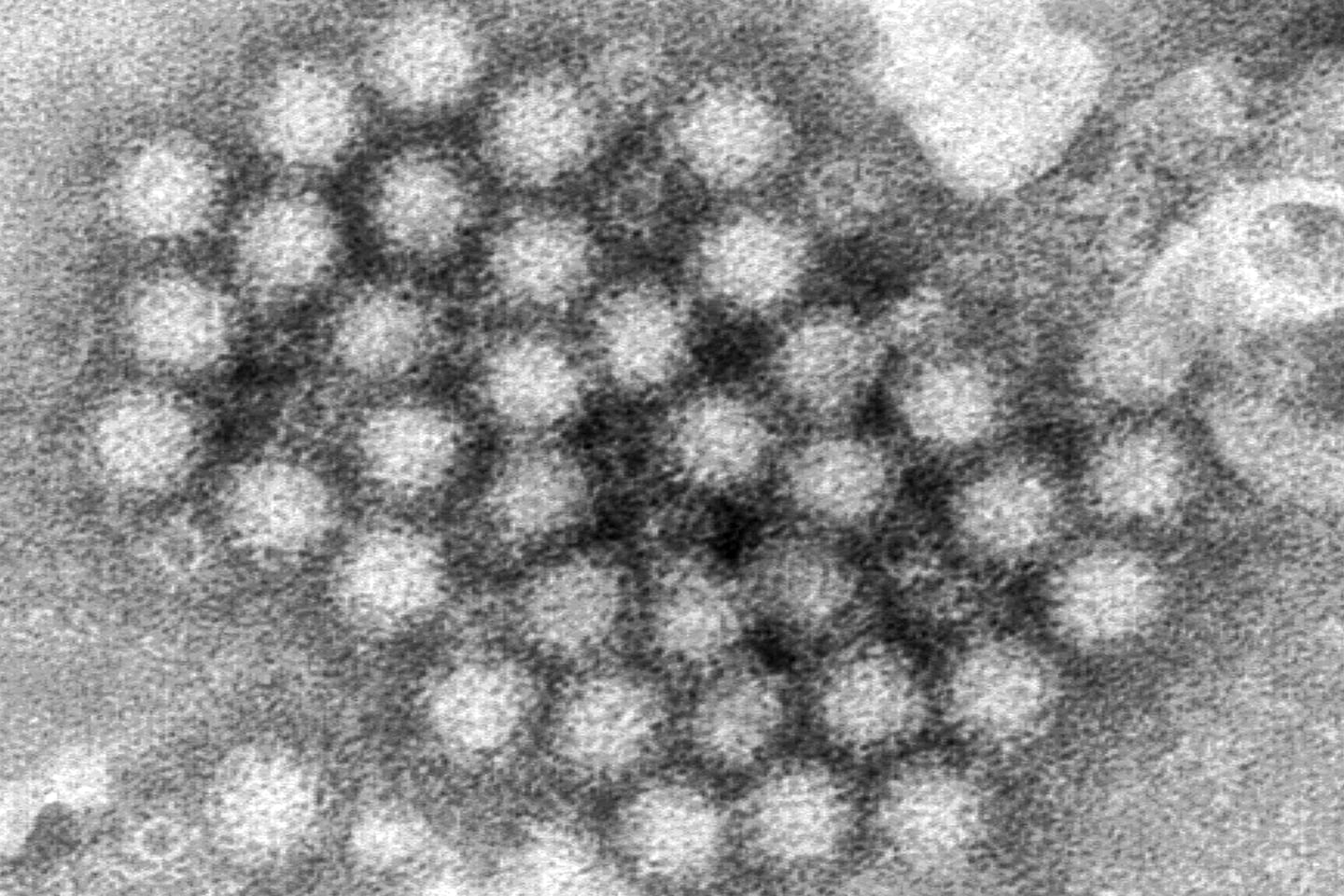 Suspected norovirus outbreak leads to elementary school closure in Medford following more than 100 student absences - The Boston Globe