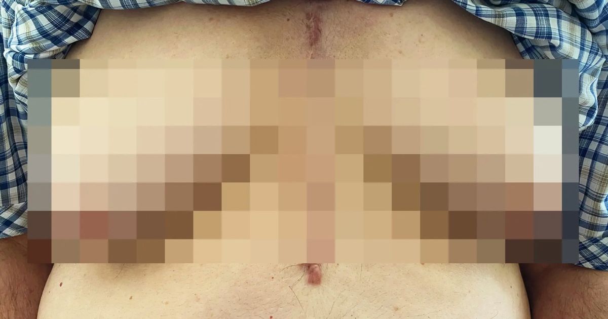 Pensioner bloke 'grows breasts' after taking common medication as warning issued - Daily Star