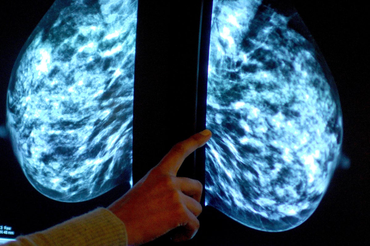 New breast cancer drug shows promising signs for treatment