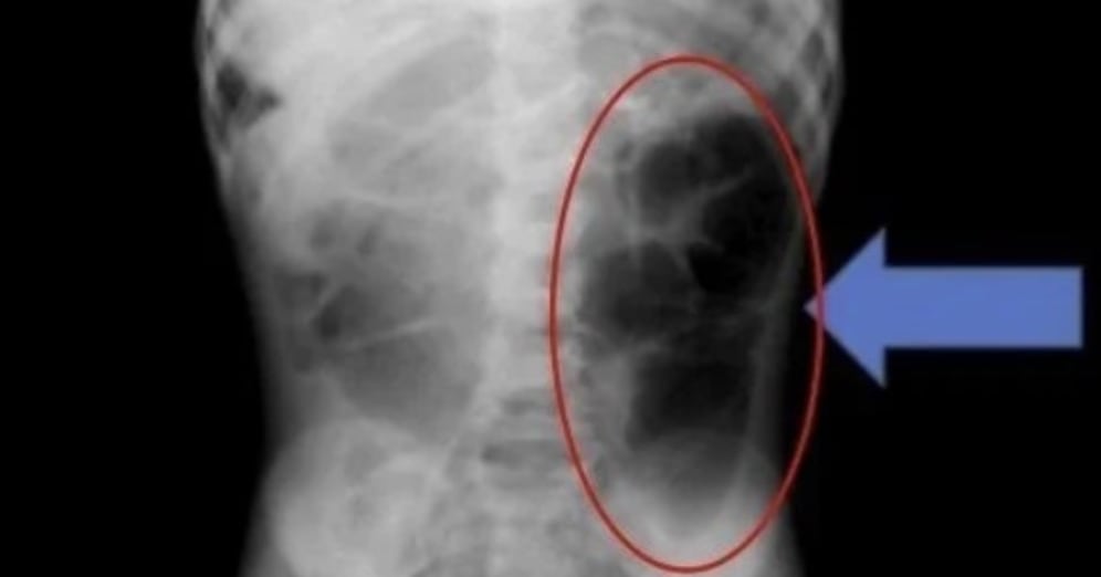 Hair Clump Discovered in 6-Year-Old Girl's Stomach