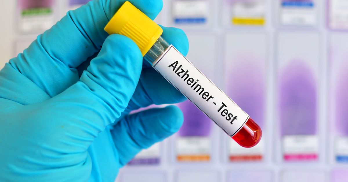 Blood test could diagnose Alzheimer's as new research looks into finger prick tests - The Mirror