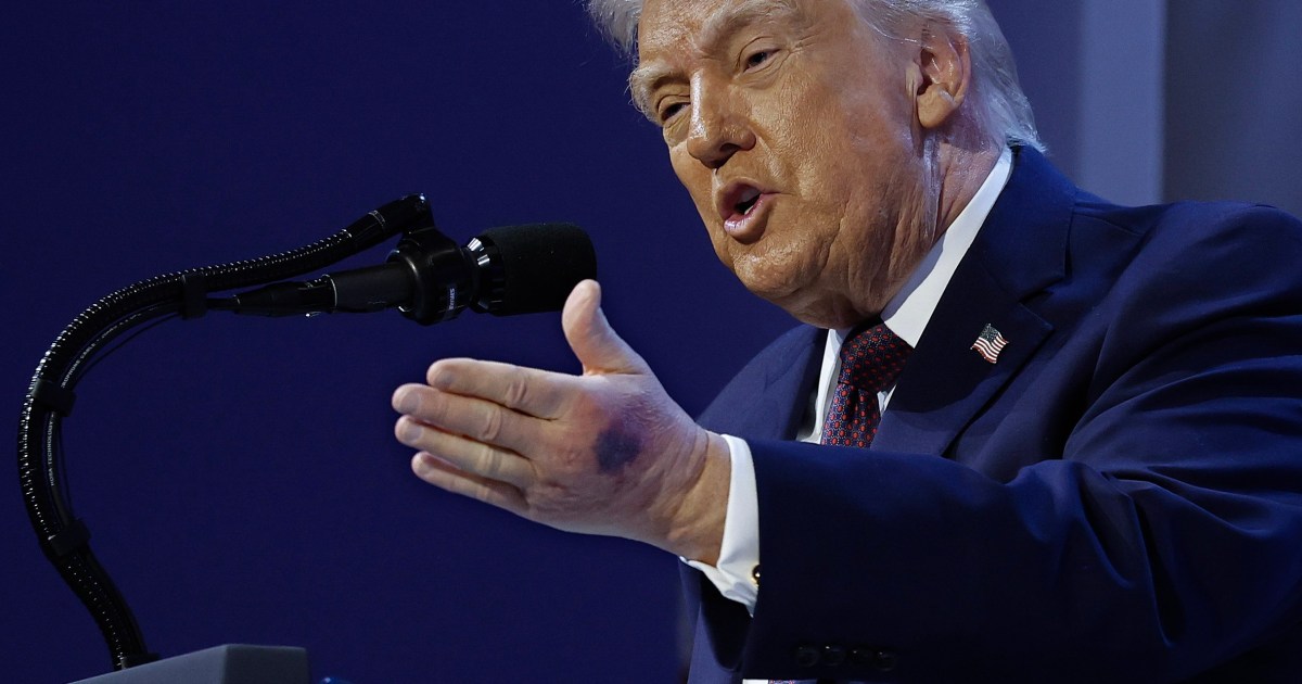 Donald Trump reveals why he has a large bruise on his left hand