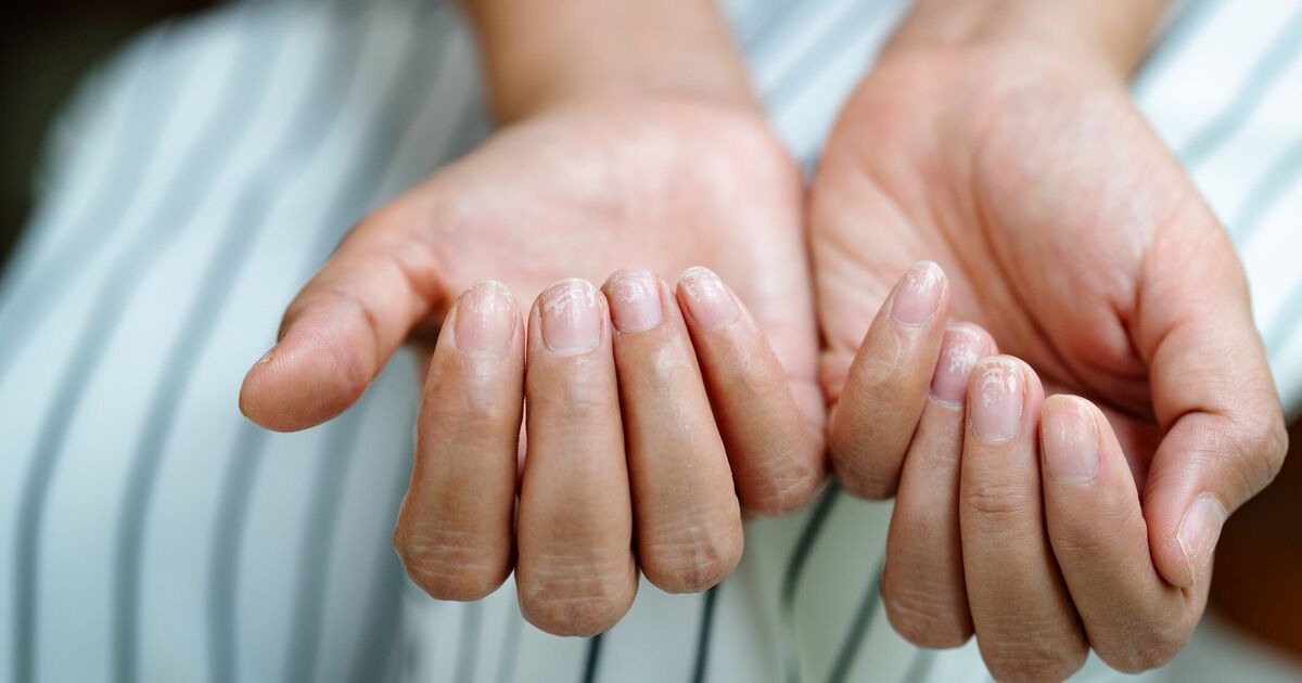 Fingernail colour changes that could signal serious diseases - what to look for
