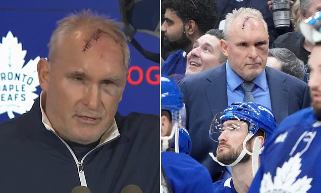 Hockey coach suffers gruesome head injury after freak accident