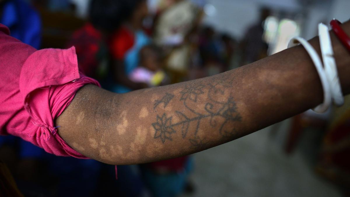 Kala Azar in India: Treading the last mile towards elimination