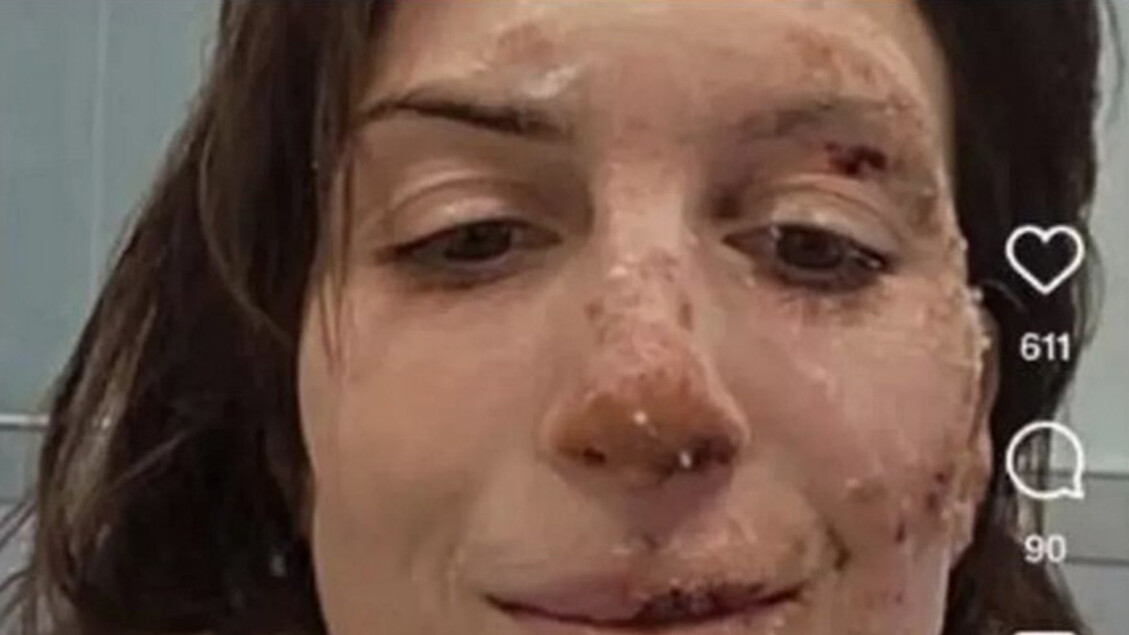 Swiss-bar-fire survivor posts photo of burned face - General News