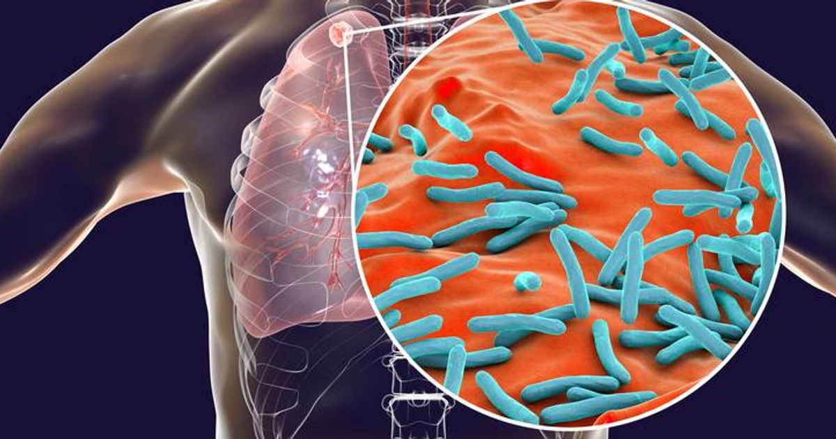 Victorian disease warning as cases surge and young Brits left 'unable to walk' - Daily Star
