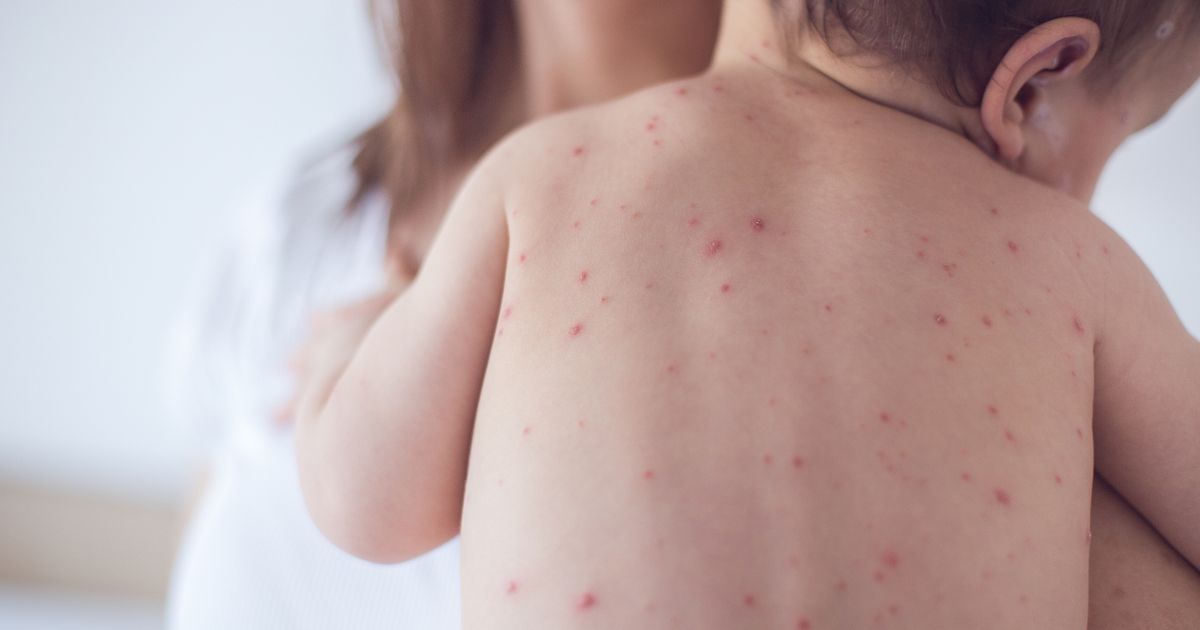 Extremely contagious disease is making a major UK comeback - see cases in your area - The Mirror