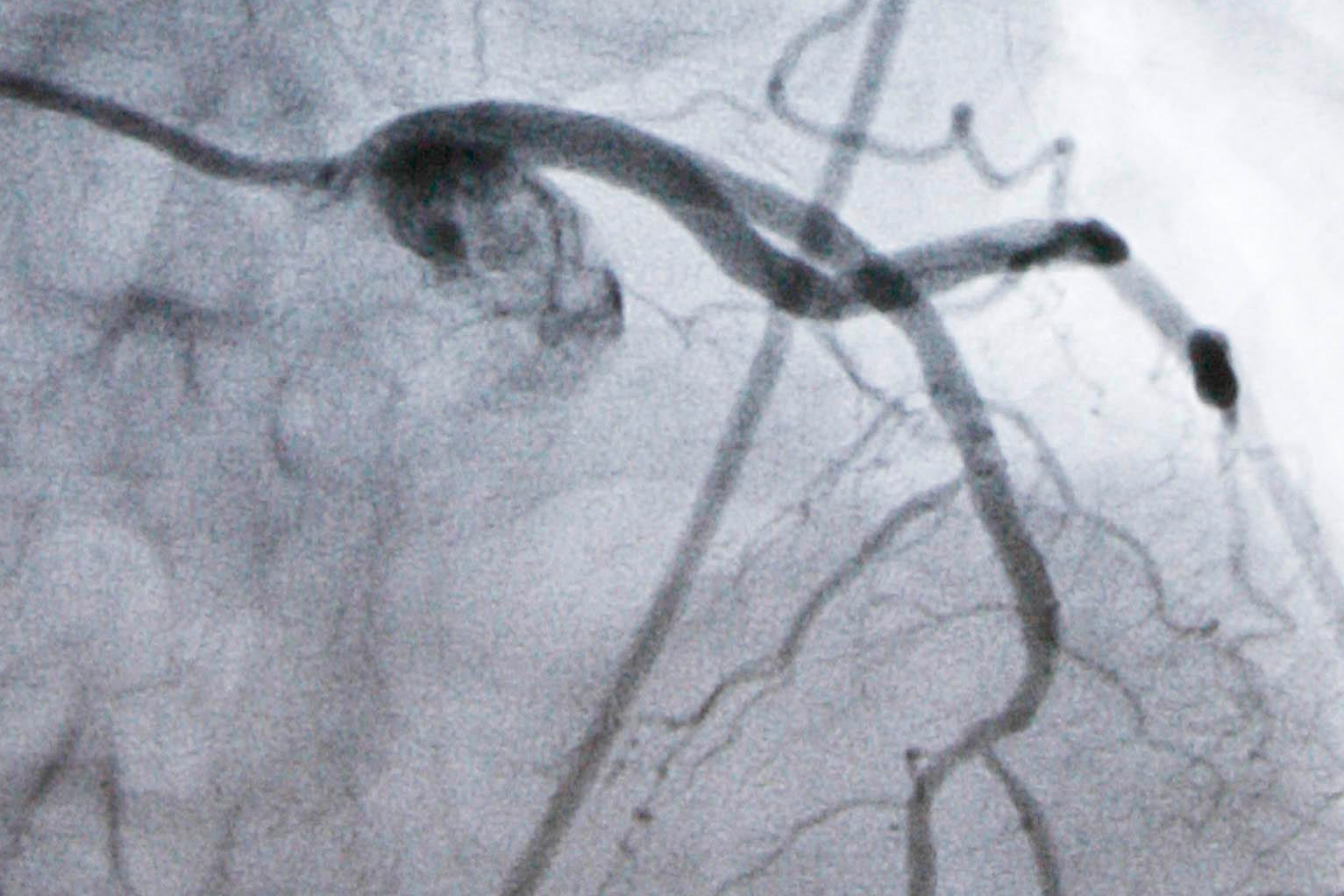 Experimental cholesterol-lowering pill may offer new option for millions