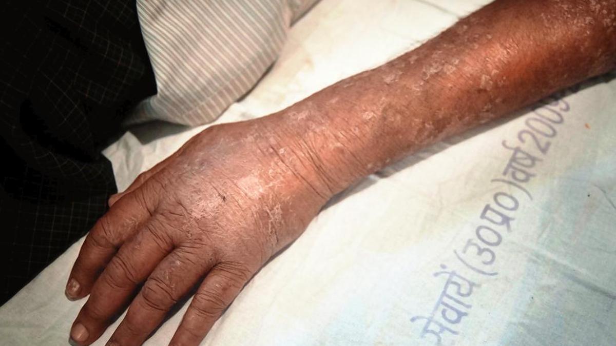 Chronic hives demands long-term care, not endless trigger searches: experts
