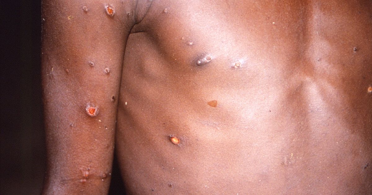 Pandemic fears explode after man dies of deadly Monkeypox virus in prison - Daily Star