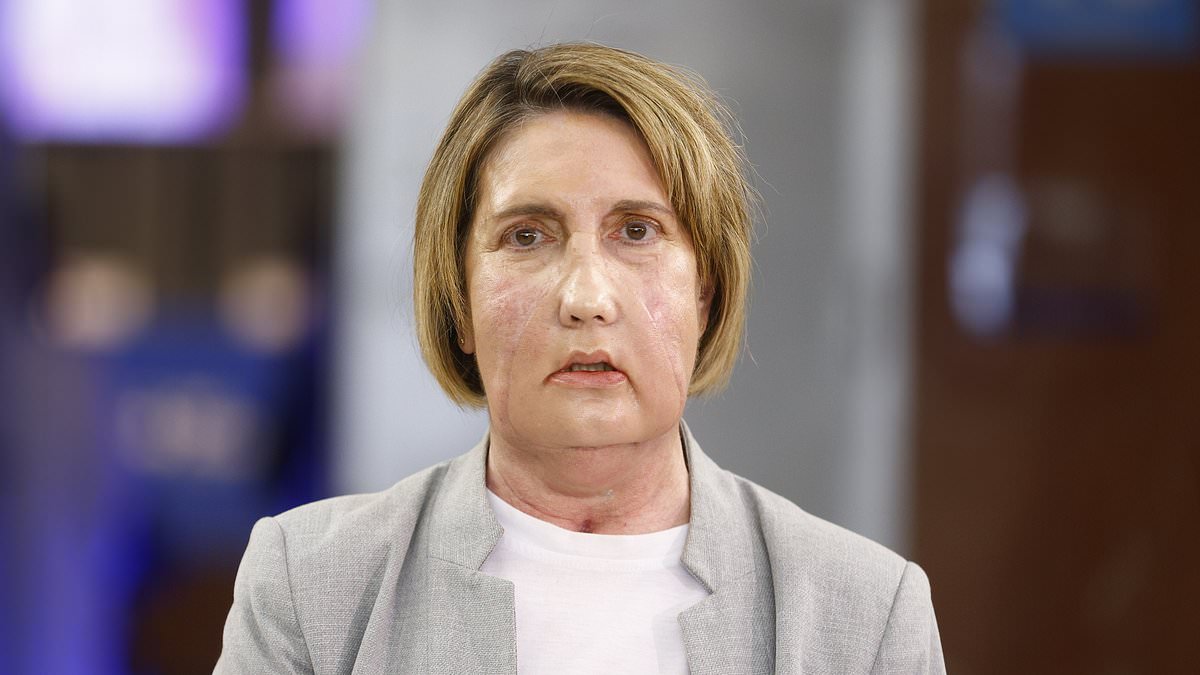 Woman with receives face transplant from assisted death donor